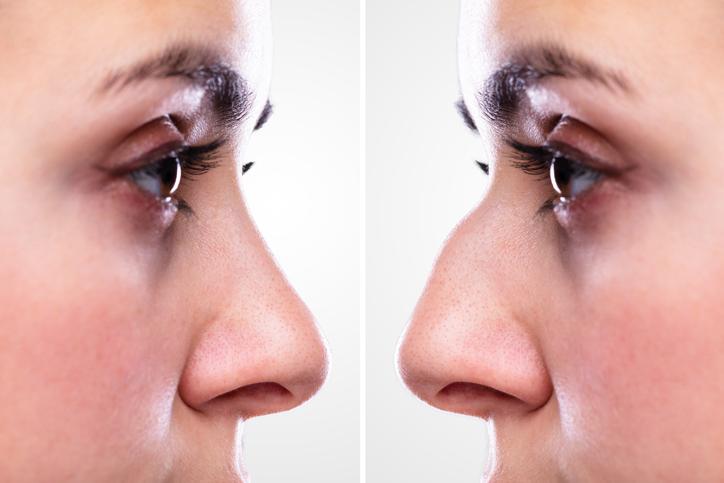 Navigating Rhinoplasty: What to Expect Before, During, and After Surgery
